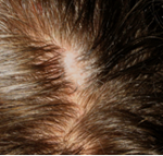 Gel applied to scalp